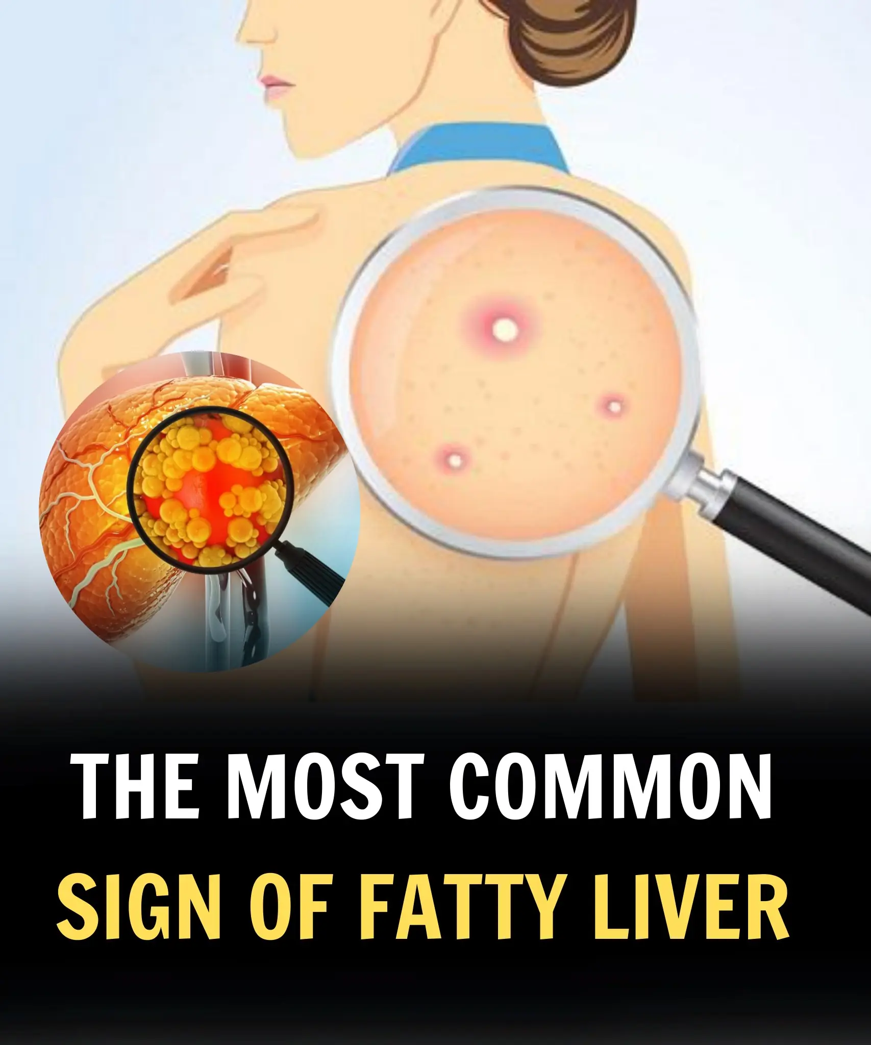 Fatty Liver: Causes, Symptoms, Treatment & Home Remedies